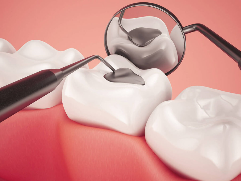 Tooth Fillings and Sealants - Mint Dental Care - Twin Falls, ID